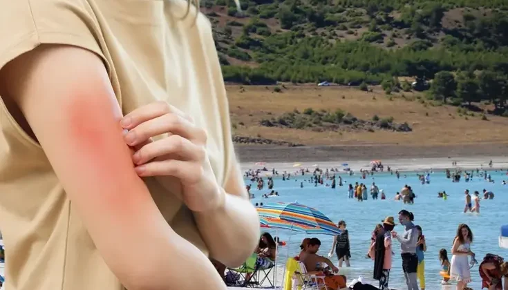 Et yiyen bakteri vakası Türkiye’de görüldü mü? Bakanlıktan açıklama